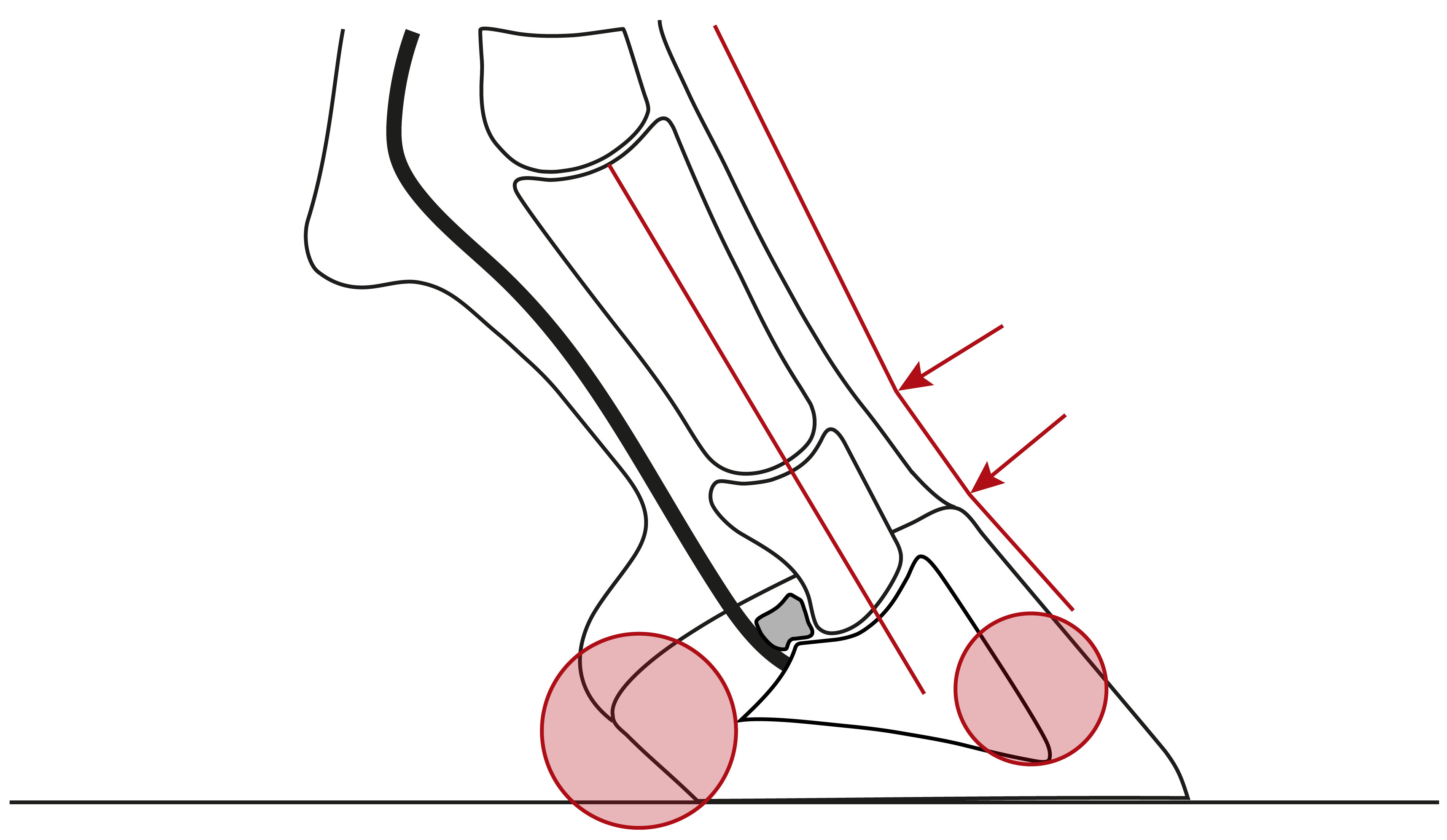 Illustration einer nach hinten gebrochenen Huf-Fessel-Achse mit einem verbreiterten Hufbeinträger und einer Überlastung der Trachten