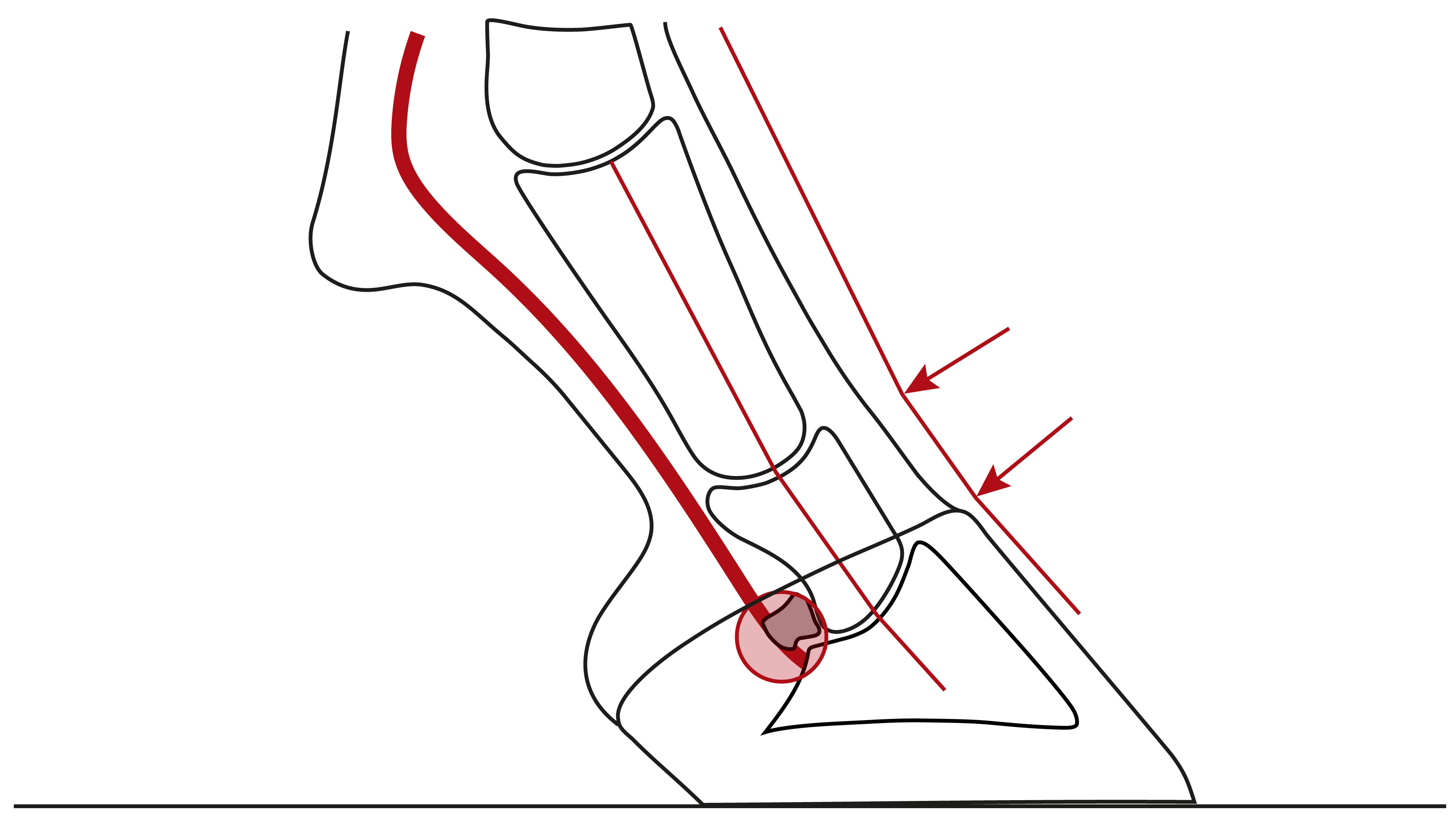 Illustration einer nach hinten gebrochenen Huf-Fessel-Achse mit einer Überstreckung von Huf- und/oder Krongelenk und einer Überlastung der Trachten, des Hufrollenschleimbeutels und ggf. der tiefen Beugesehne