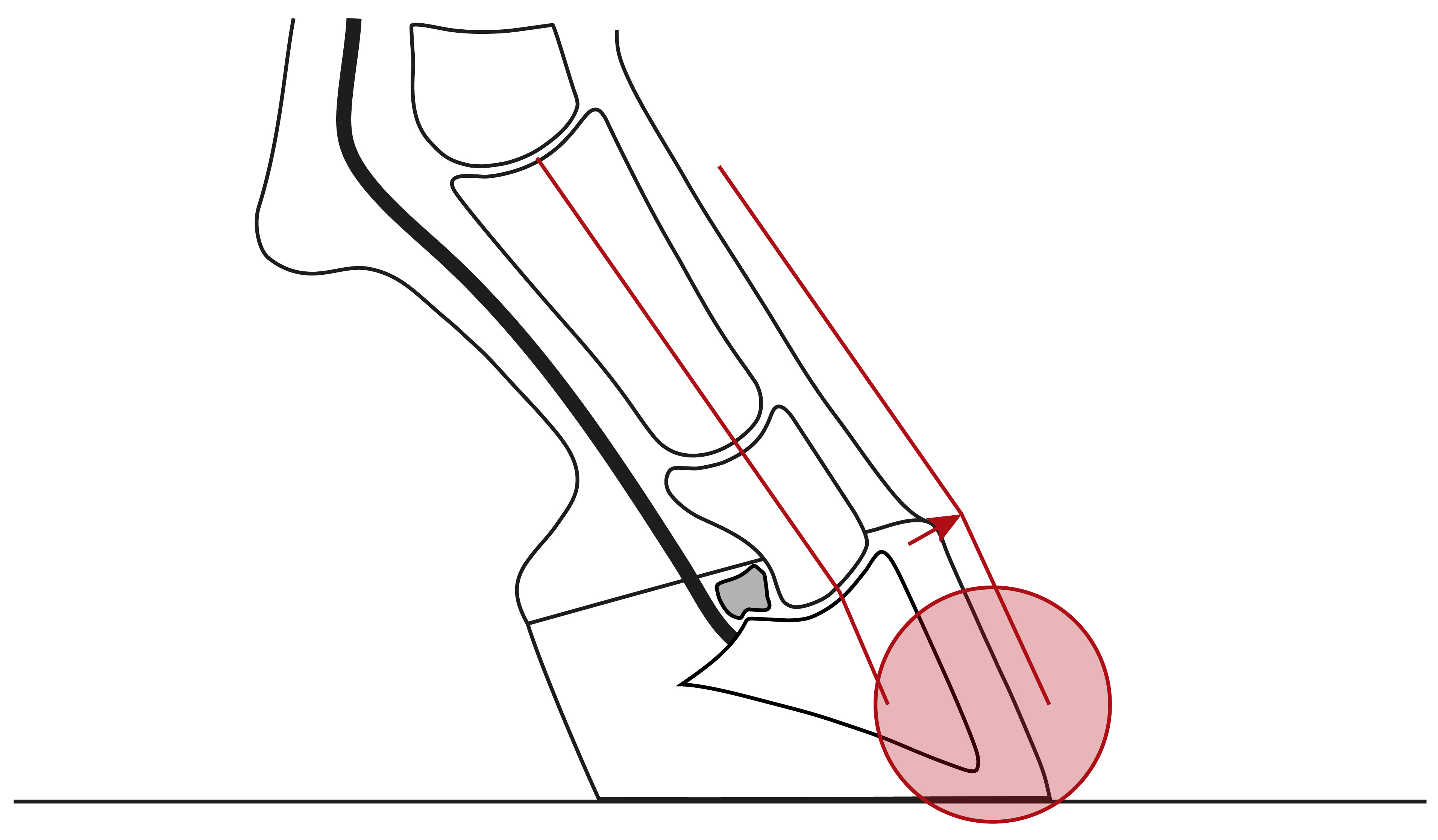 Illustration einer nach vorne gebrochenen Huf-Fessel-Achse mit einer Beugung des Hufgelenks und einer höheren Belastung der Zehe