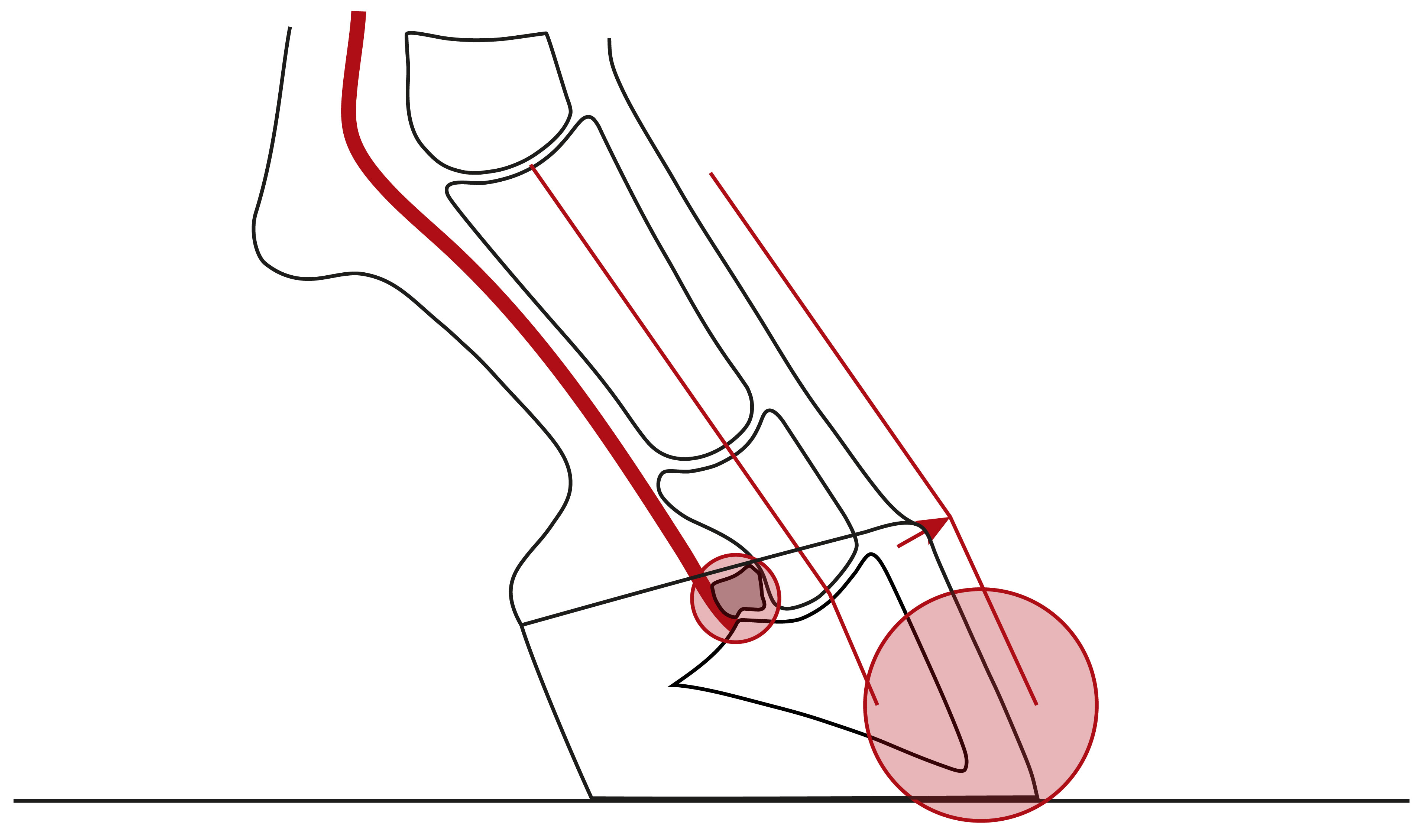Illustration einer nach vorne gebrochenen Huf-Fessel-Achse, verursacht durch die stark angespannte tiefe Beugesehne eines Sehnenstelzfußes