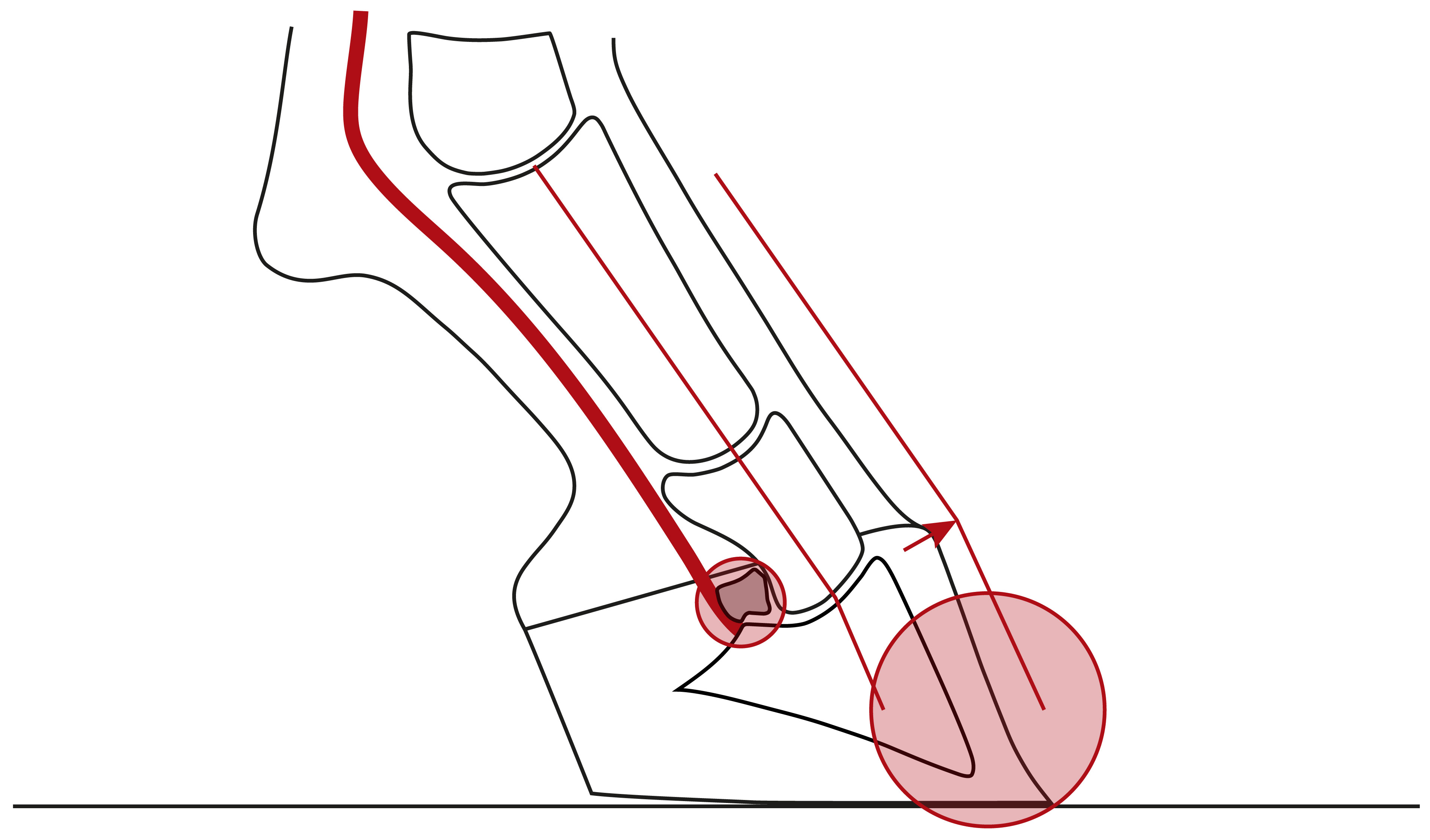 Illustration mit einer nach vorne gebrochenen Huf-Fessel-Achse und konkavem Verlauf der Zehe aufgrund zu sehr gekürzten Trachten
